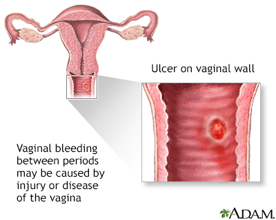 irregular bleeding during period