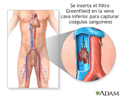 Si es posible volar en el avión con varikozom de los pies